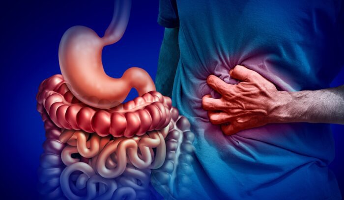 3d illustration of gut and stomach pain, for article on Crohn's disease remission