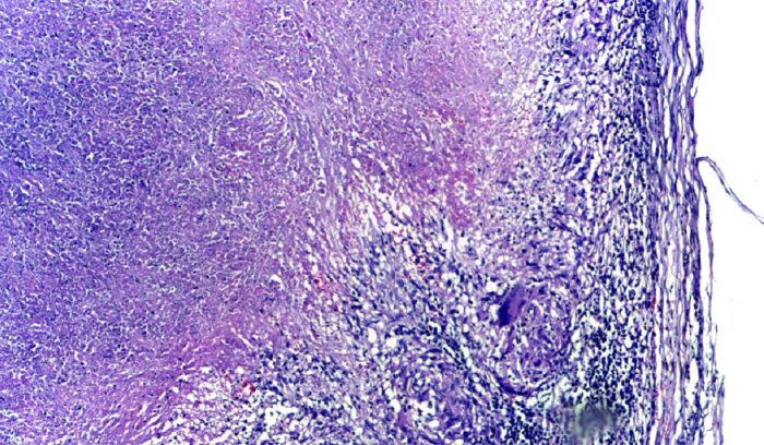 Microscopy of tuberculous epididymitis, for article on streptomycin isolation