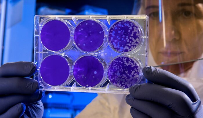Scientist examines the result of a plaque assay, for article on gene therapy cure MLD