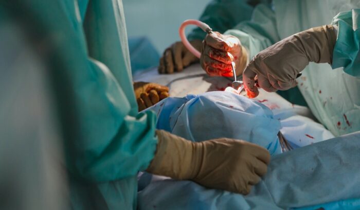 A surgical team performing a complex organ procedure for an article about bladder transplant surgery, for article on bladder transplant