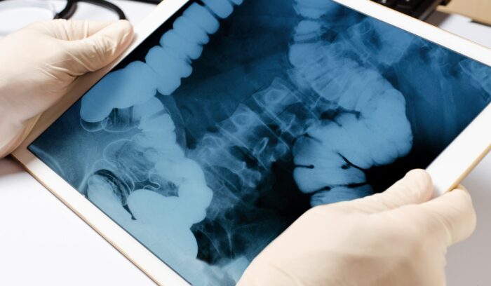 X-ray image of the intestine