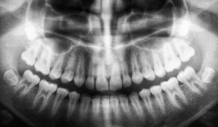X-ray of teeth, for article on prehistoric dental treatment