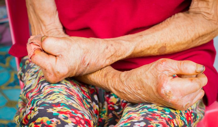 Closeup hands of old woman suffering from leprosy, for article on leprosy elimination