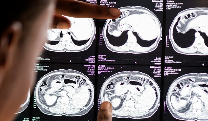 A researcher examining brain scan imaging for an article about Parkinson's stem cell treatment — 14 words.