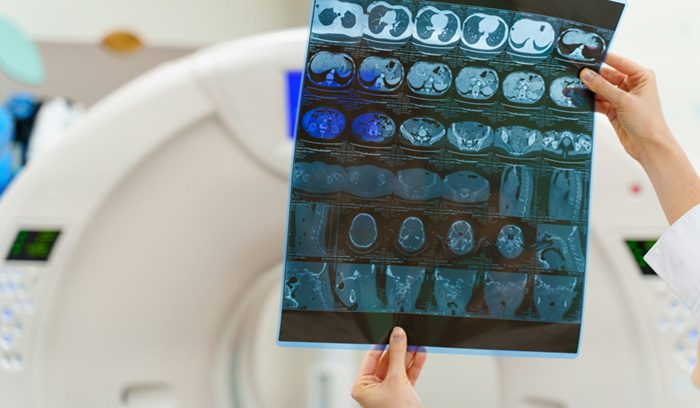 Researcher examining brain scan imagery for an article about Alzheimer's prevention trial results